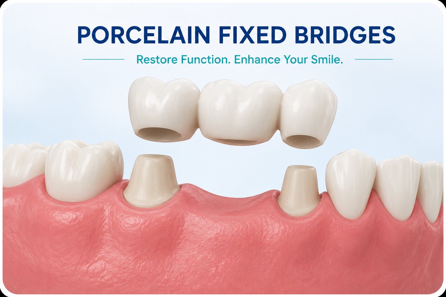 Porcelain fixed bridges for replacing missing teeth